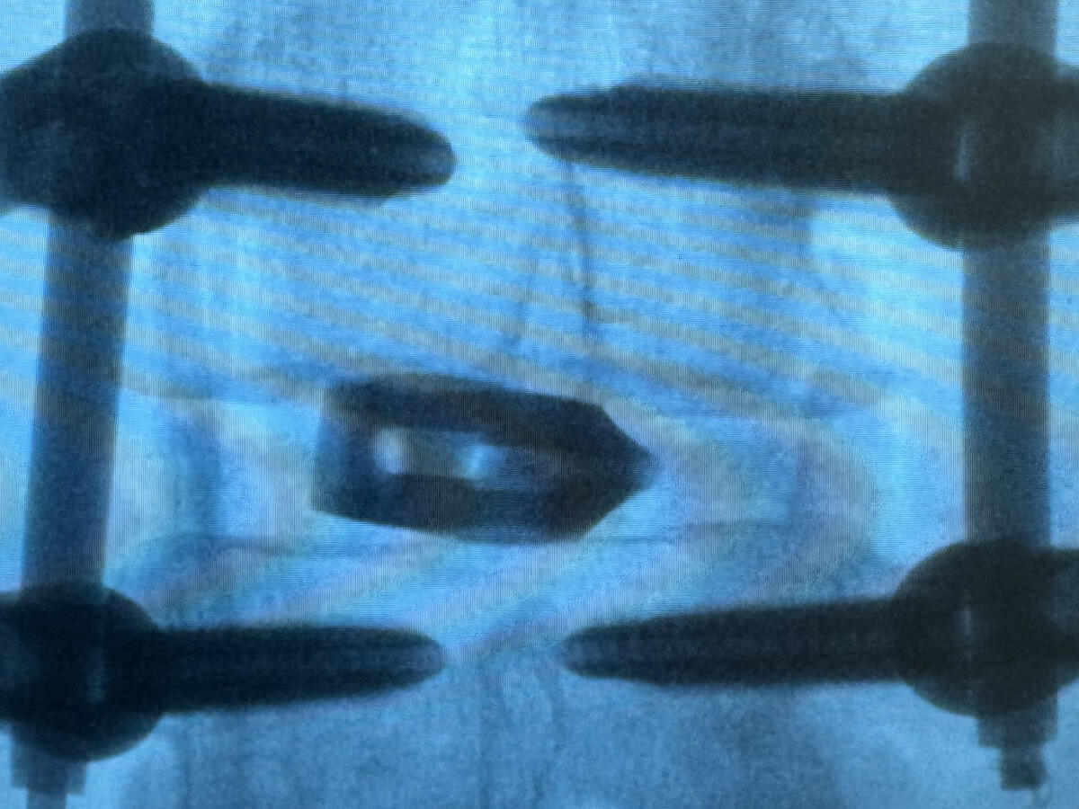 X-ray showing spinal fixation hardware used in advanced spine surgery. X-ray showing spinal fixation hardware used in advanced spine surgery.